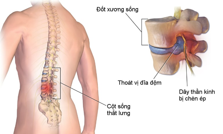 Cơn đau của bệnh thoát vị đĩa đệm là do các bao xơ đĩa đệm chứa các chất keo nhầy bị nứt rách. Từ đó, các chất keo nhầy bị thoát ra ngoài, chèn ép các dây thần kinh, gây đau.